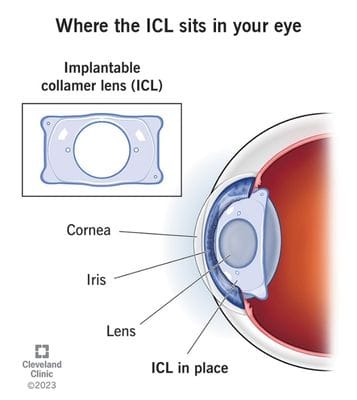 Kas yra EVO ICL - (implantuojamas „Collamer“ objektyvas)