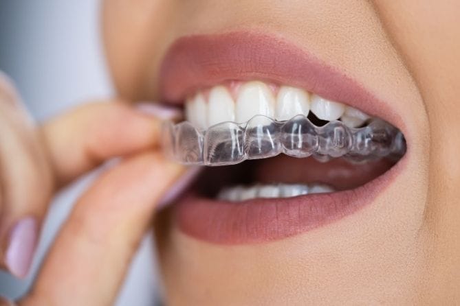 What Are Clear Aligners and Why Are They Popular