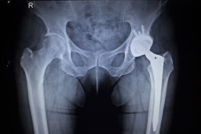 Which Implants and Segments Are Most at Risk