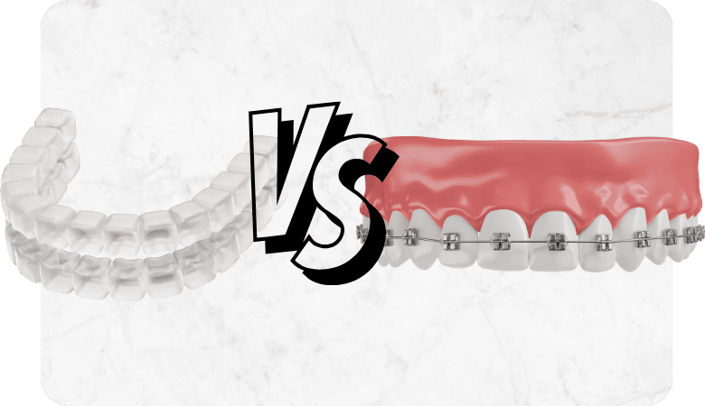 Why Are More People Choosing Clear Aligners Over Traditional Braces