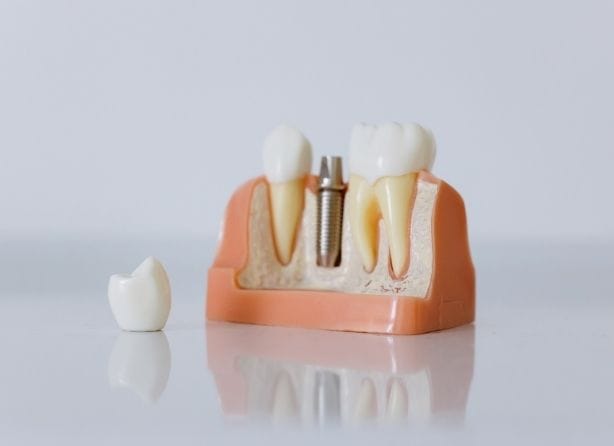 How China’s Procurement Strategy Is Influencing Dental Implant Growth