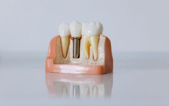 Top 5 Dental Implant Companies Leading the Global Market