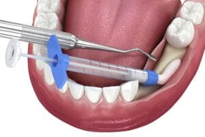 dental bone graft companies