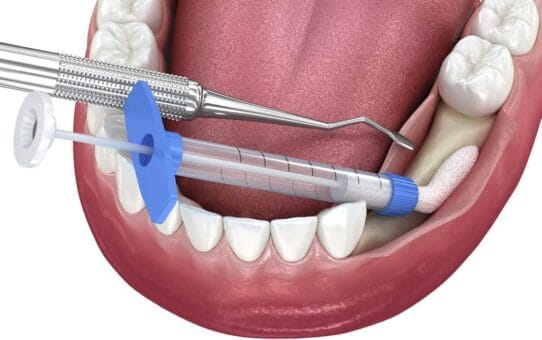 Top 3 Dental Bone Graft Companies in 2026