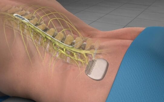 Spinal Cord Stimulation: Abbott vs Medtronic 2026