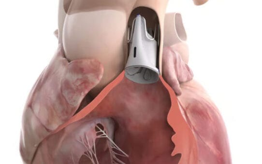 Pediatric Heart Valve: Edwards AUTUS FDA Approval in 2026